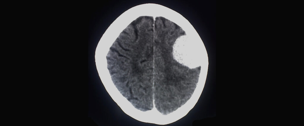 ilustração de meningioma cerebral
