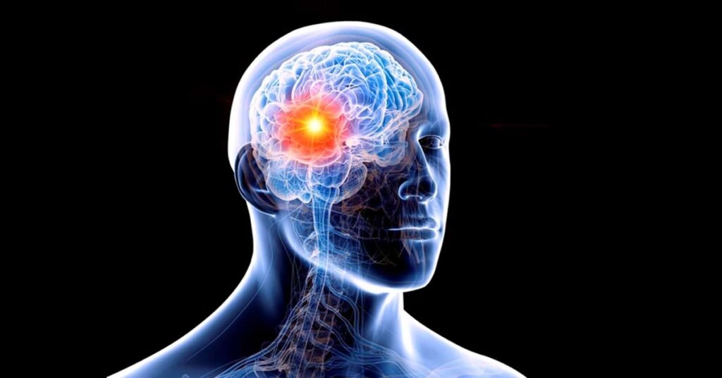 Metástase cerebral