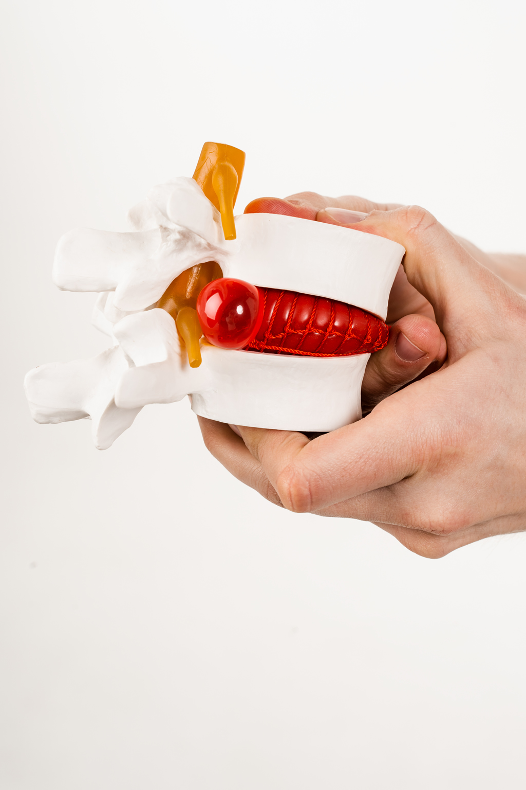 Sintomas de hérnia de disco: quando procurar um neurocirurgião