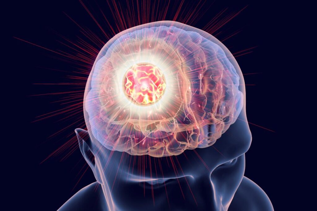 glioblastoma tratamento sintomas